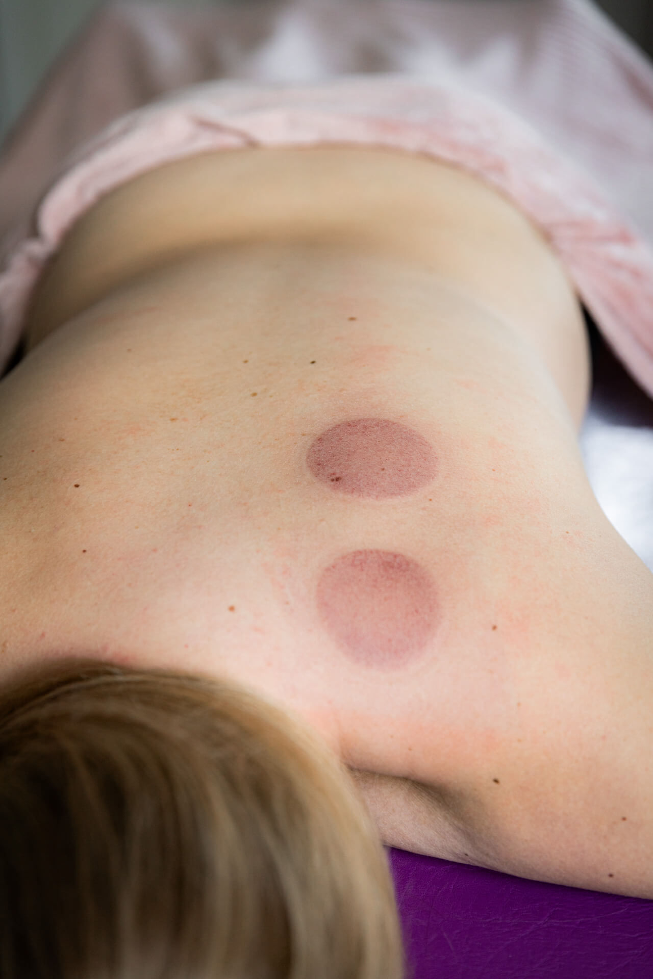 man sieht die Abdrücke vom Schröpfen am Rücken einer jungen Dame